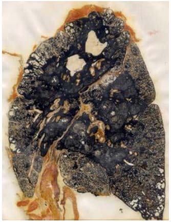 Figure 2—specimen of a lung with Progressive Massive Fibrosis